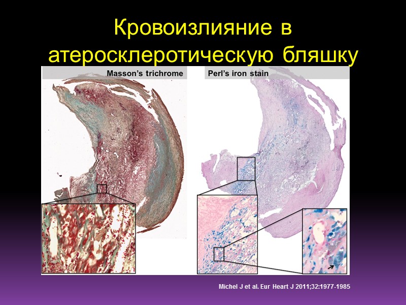 Кровоизлияние в атеросклеротическую бляшку Michel J et al. Eur Heart J 2011;32:1977-1985